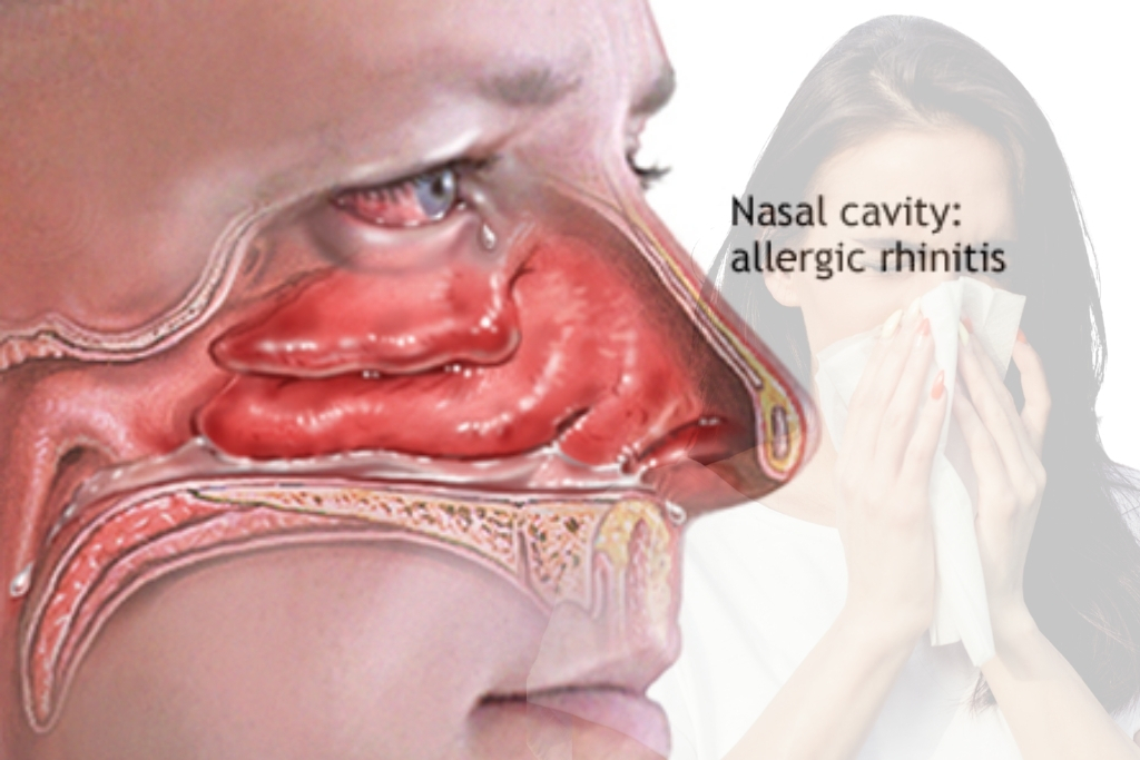 Allergic rhinitis treatment by pulmonologist in Vadodara
