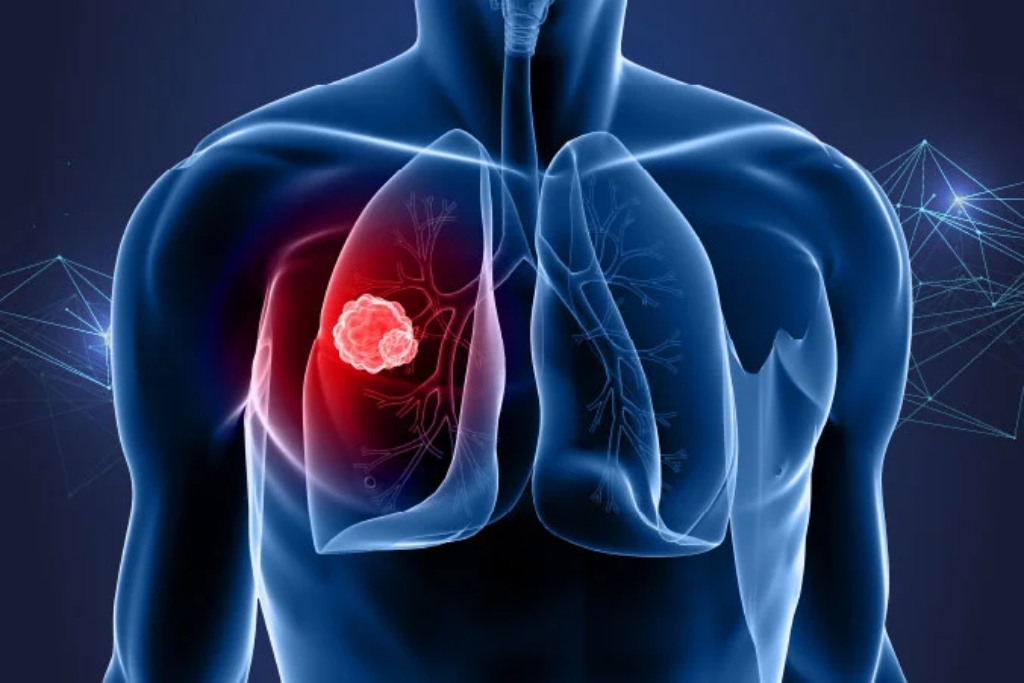 Lung cancer treatment by pulmonologist in Vadodara